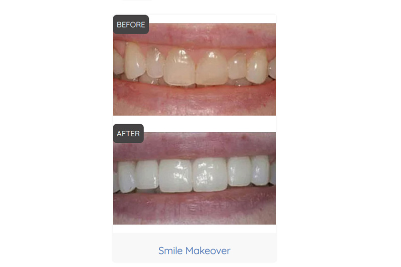 Smile Makeovers in Madison